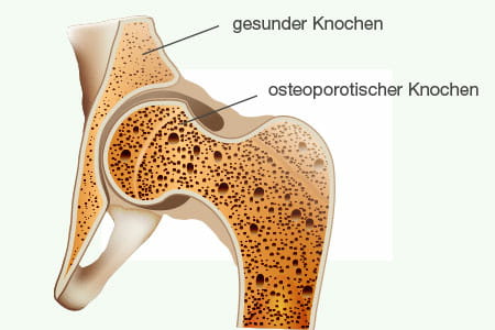FuerMich_Osteoporose-Knochen